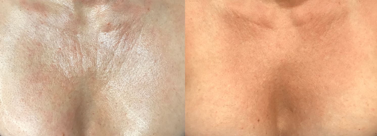 Using Wrinkle reduction treatment and Fillers for Chest and Cleavage  Rejuvenation - SkinHampshire - Wrinkle reduction treatment in Basingstoke